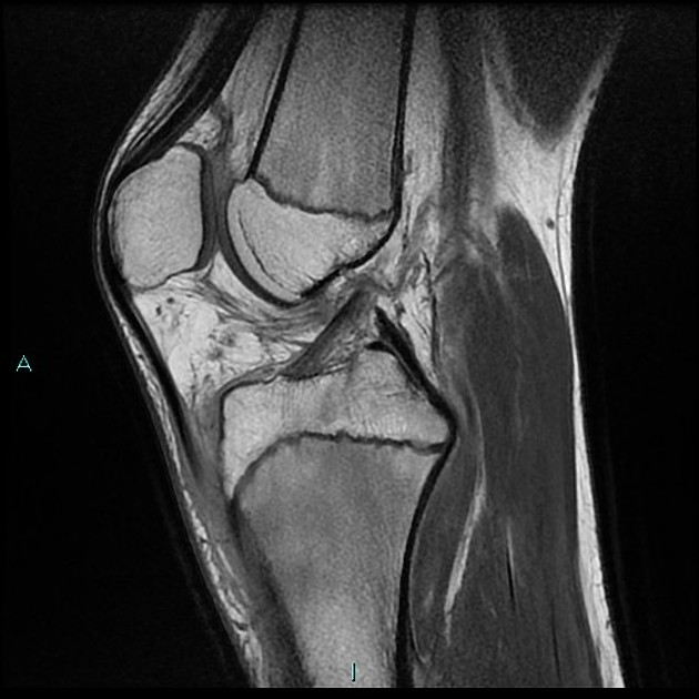 Chronic osteomyelitis with Brodie abscess Radiology Case