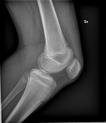 Chronic osteomyelitis with Brodie abscess Radiology Case