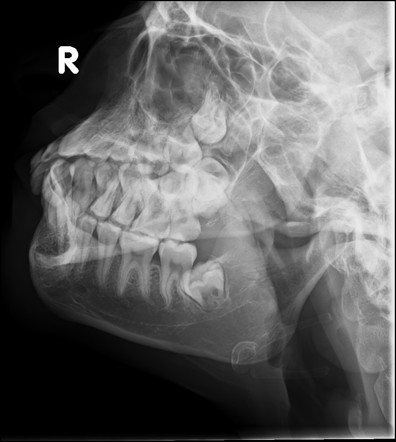 Oblique Line Of Mandible