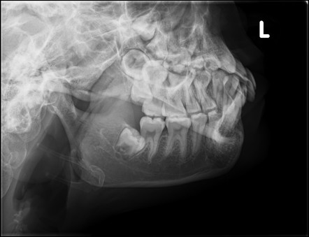 Normal Mandible Radiographs Image Radiopaedia Org