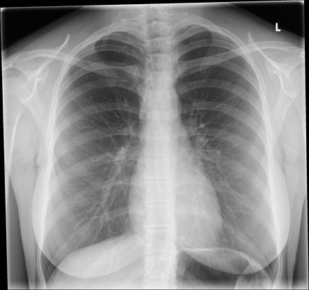 Cervical rib | Radiology Reference Article | Radiopaedia.org