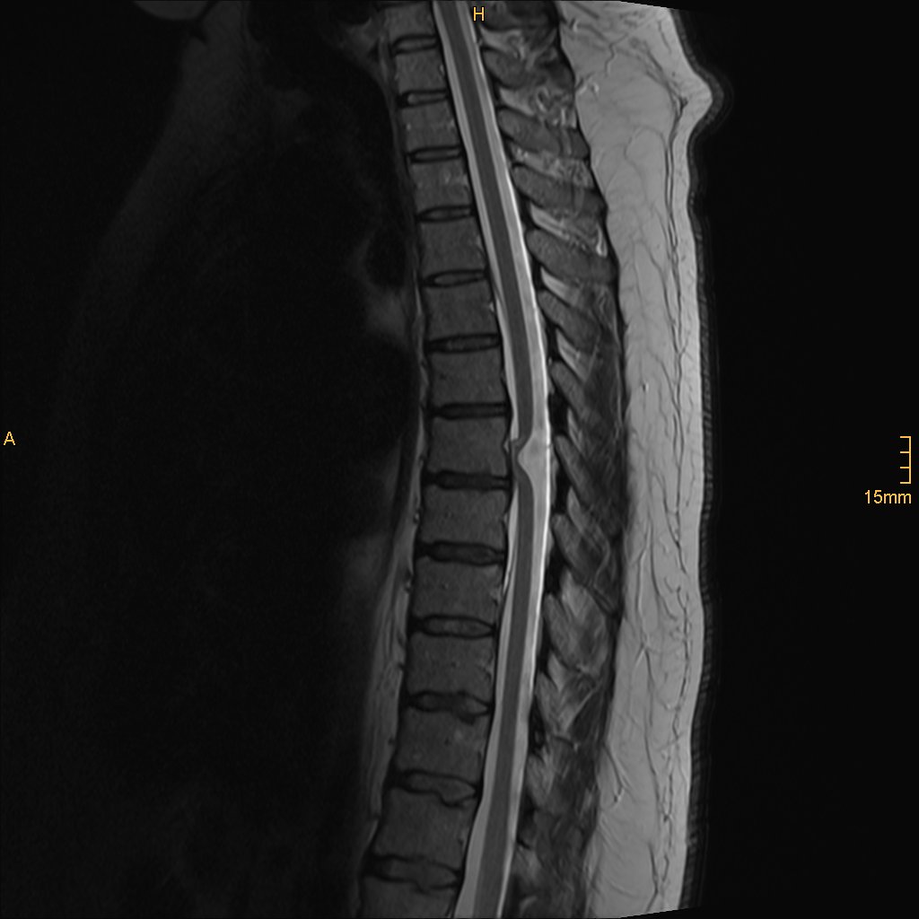 Idiopathic Spinal Cord Herniation Thoracic Image Radiopaedia Org