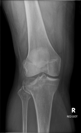 Schatzker type II tibial plateau fracture | Radiology Case ...