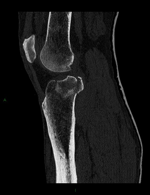 Schatzker type II tibial plateau fracture | Image | Radiopaedia.org