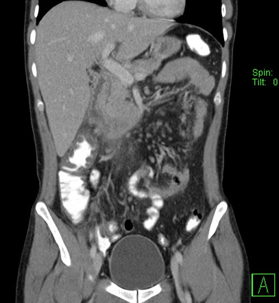 Colitis - infectious | Radiology Case | Radiopaedia.org