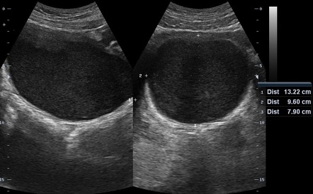 Hematocolpos | Radiology Reference Article | Radiopaedia.org