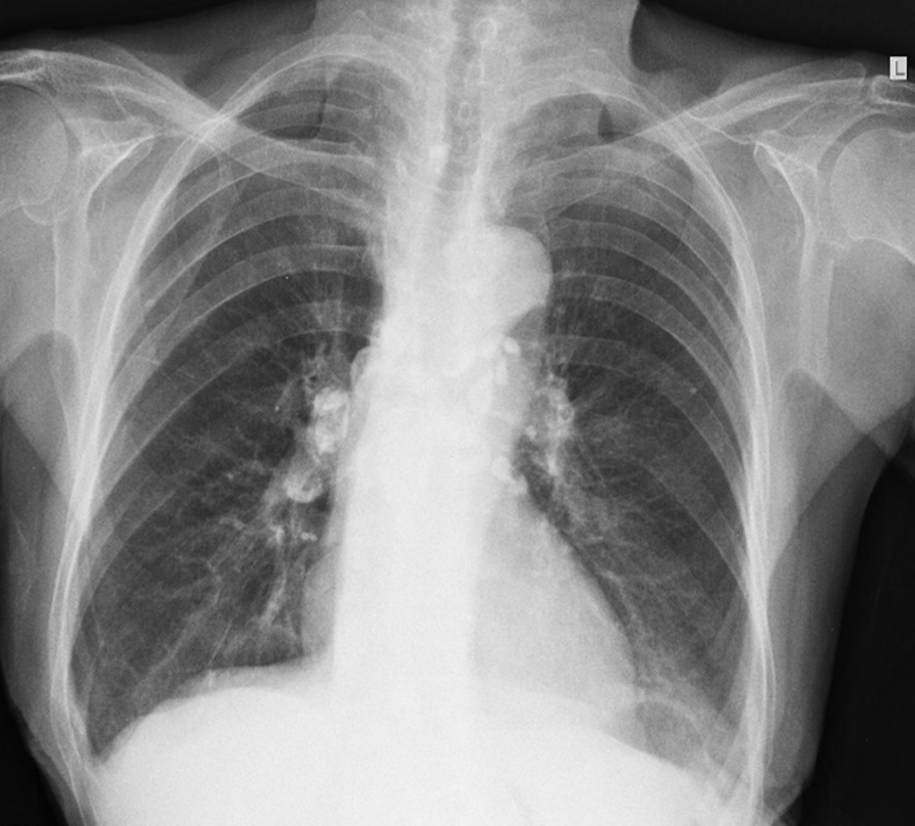 Primary Pulmonary Tuberculosis Ranke Complex Radiology Case Radiopaedia Org