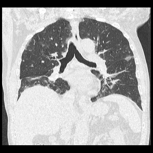 COVID-19 pneumonia | Image | Radiopaedia.org