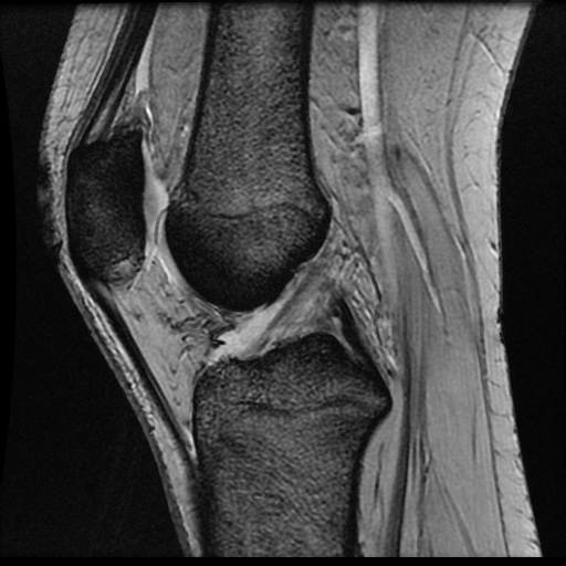 Normal MRI Knee | Image | Radiopaedia.org