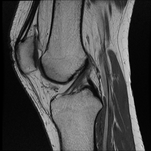 Normal Mri Knee Image Radiopaedia Org