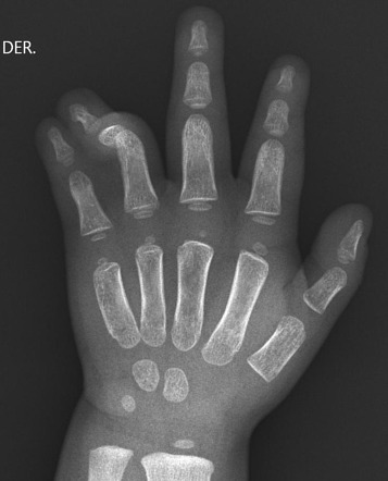 Syndactyly | Radiology Case | Radiopaedia.org