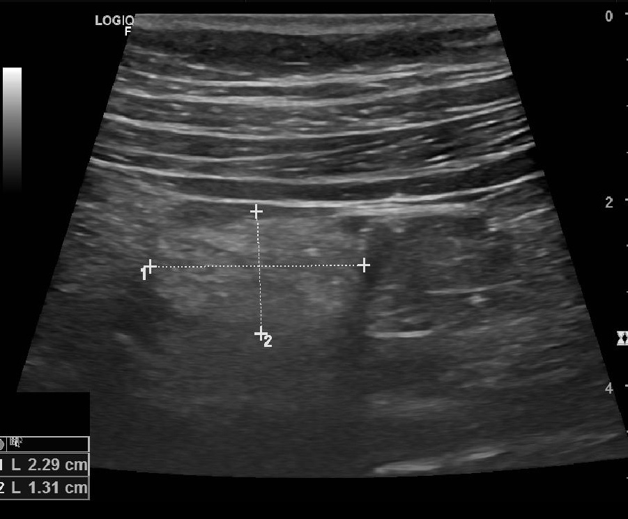 What Is Epiploic Appendagitis How Is It Treated