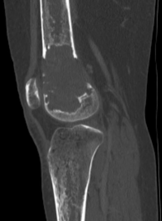 Non-ossifying fibroma (NOF) | Image | Radiopaedia.org