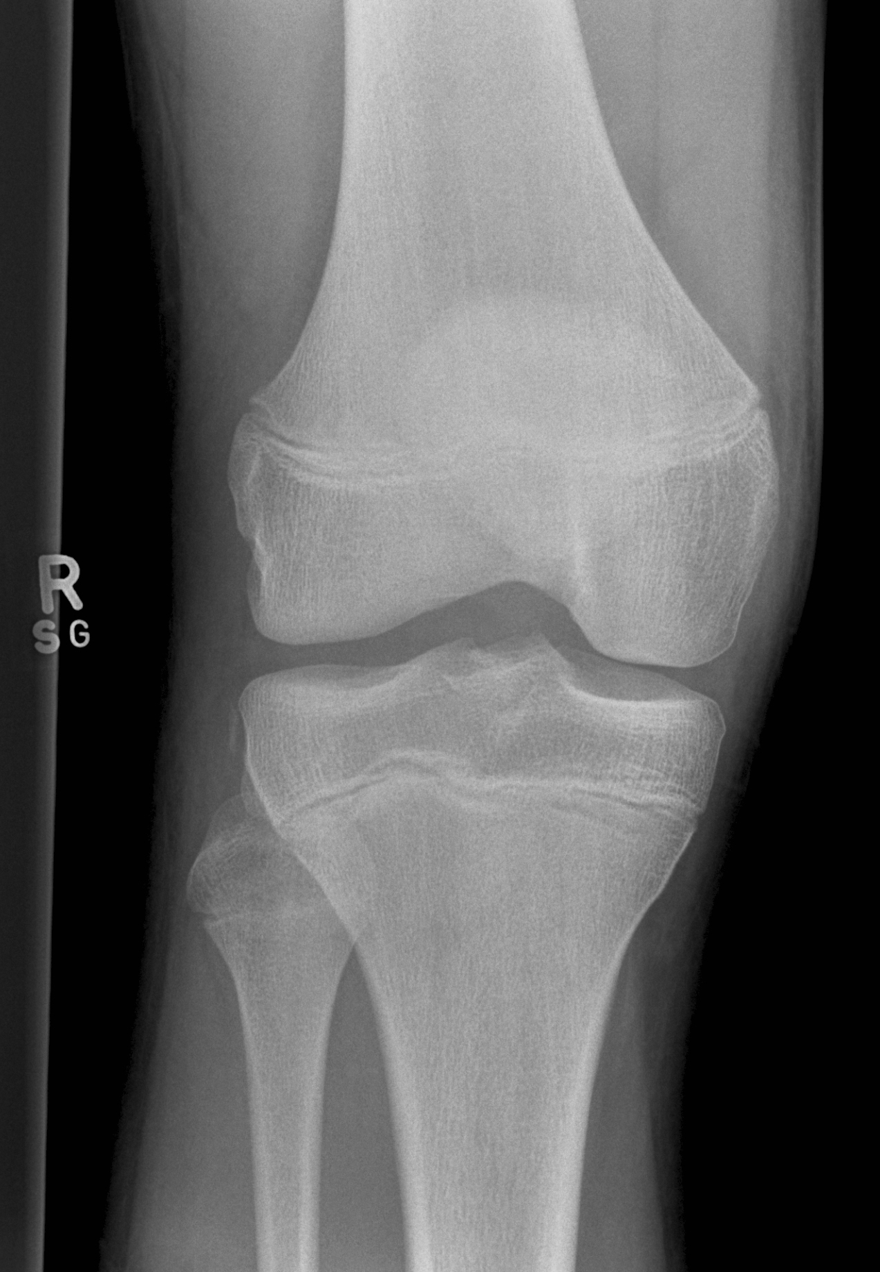 Segond fracture | Image | Radiopaedia.org