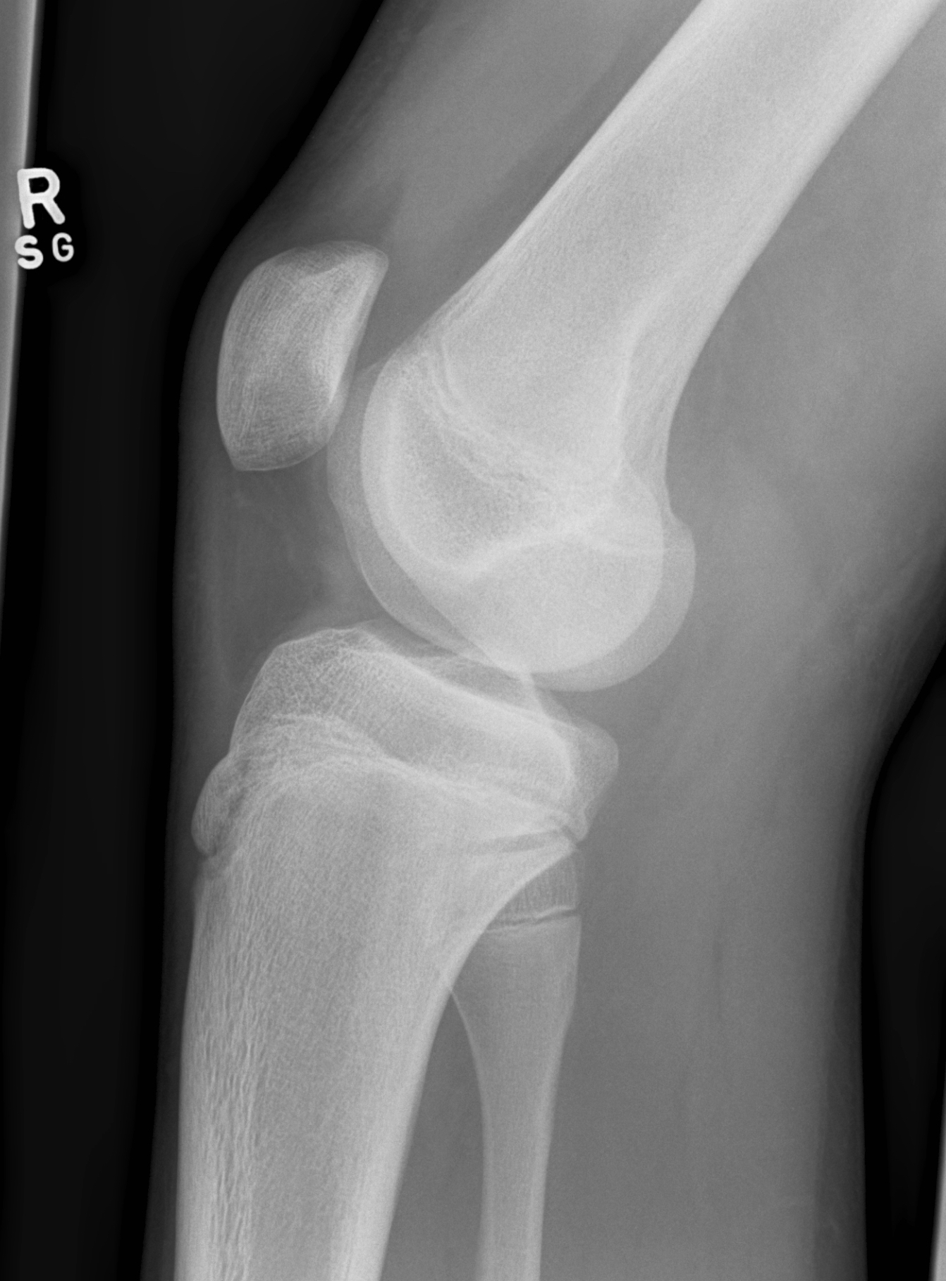 Segond fracture | Image | Radiopaedia.org