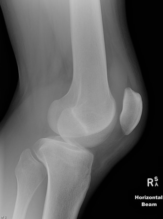 Medial avulsion fracture of the knee | Image | Radiopaedia.org