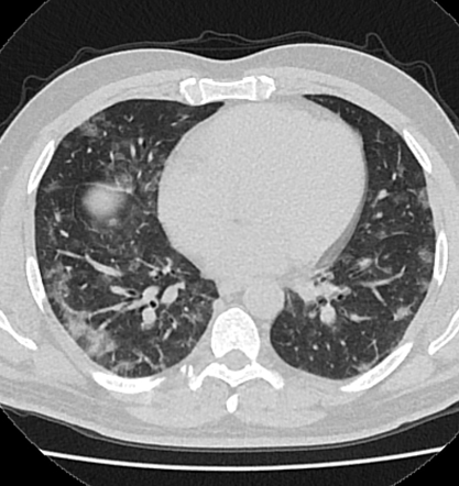 COVID-19 | Radiology Reference Article | Radiopaedia.org