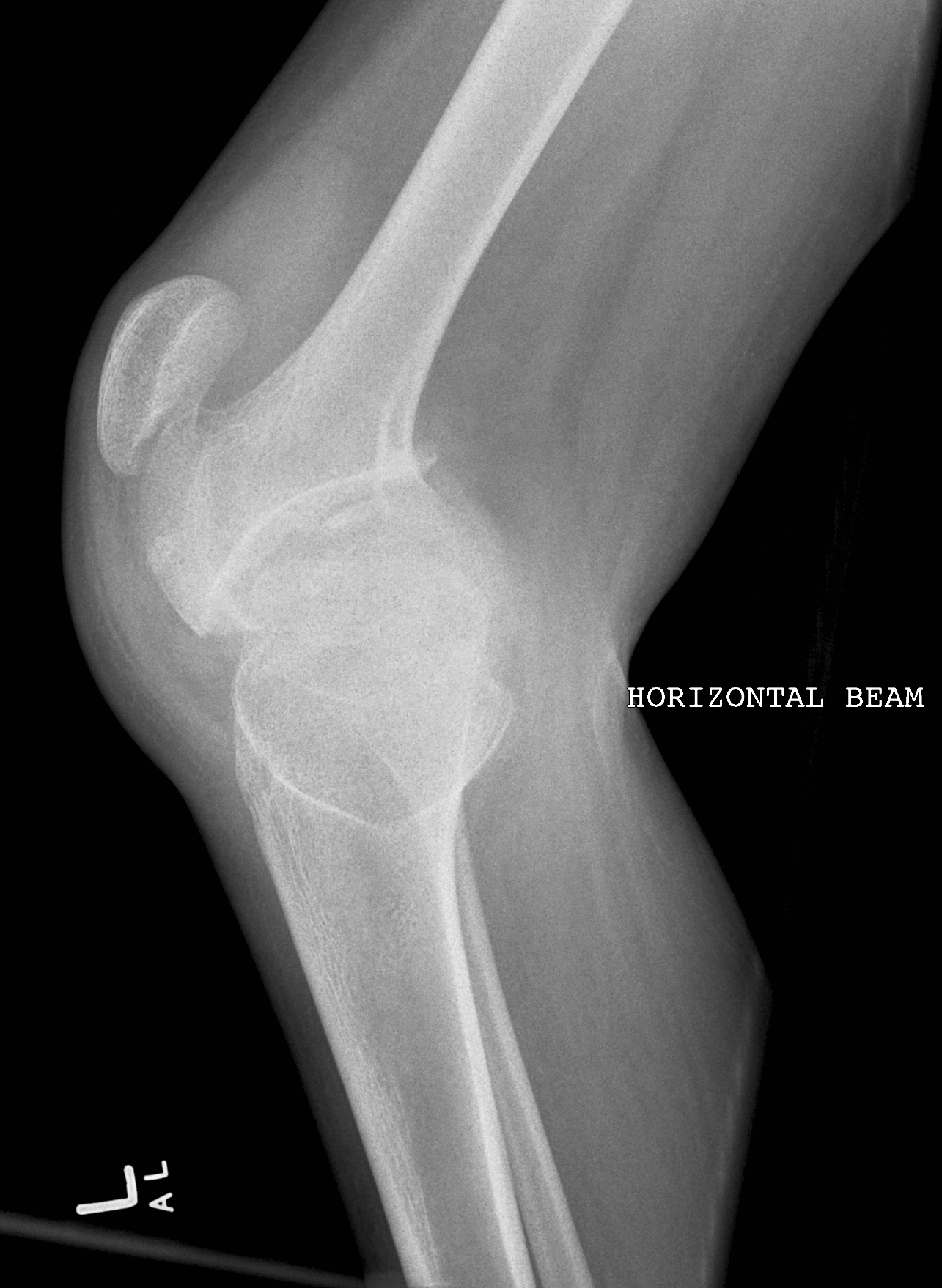 Charcot arthropathy of the knee | Image | Radiopaedia.org