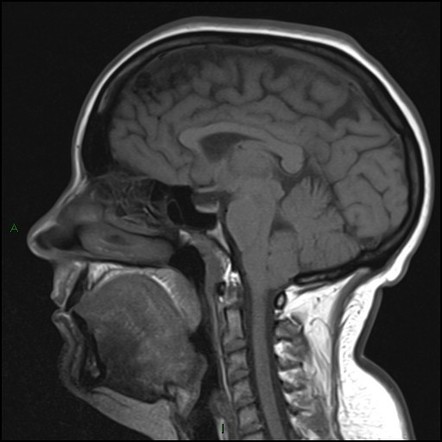 Arachnoid cyst - cerebellopontine angle | Image | Radiopaedia.org