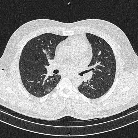 COVID-19 pneumonia | Radiology Case | Radiopaedia.org