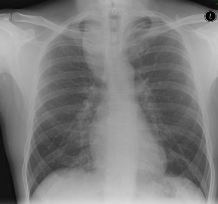 Ganglioneuroma | Radiology Case | Radiopaedia.org