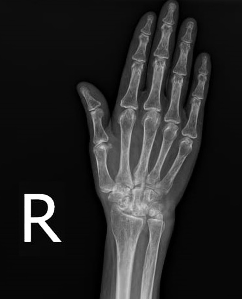 Rheumatoid Arthritis Radiology Case Radiopaedia Org