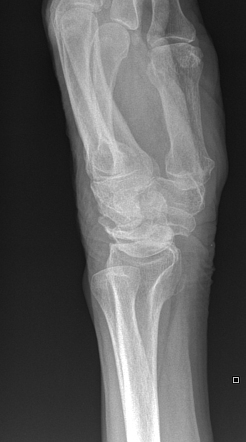 Dorsal intercalated segment instability | Radiology Reference Article ...