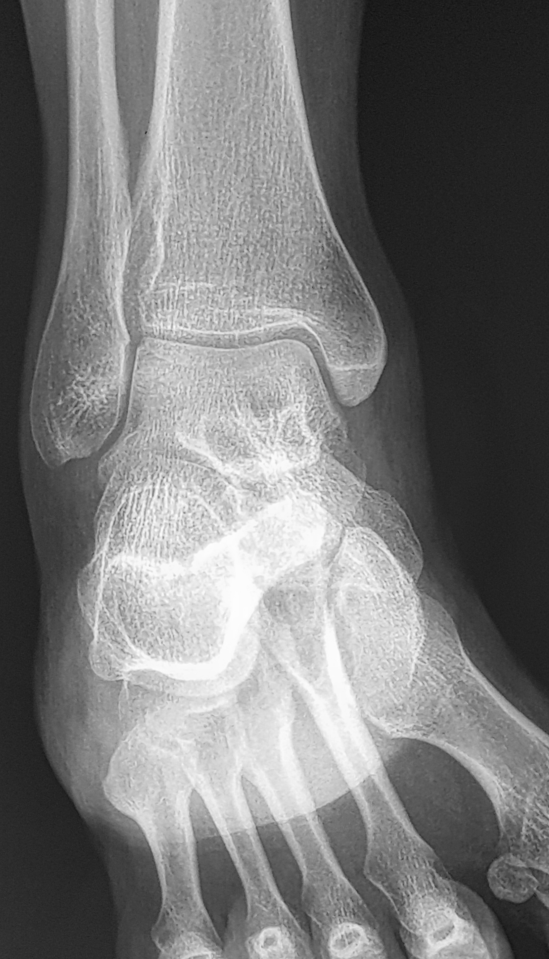 Pigmented villonodular synovitis - ankle | Image | Radiopaedia.org