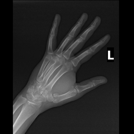 Rolando fracture | Image | Radiopaedia.org