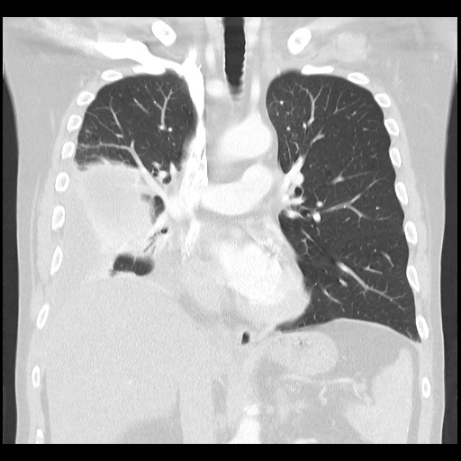 Thoracic empyema | Image | Radiopaedia.org