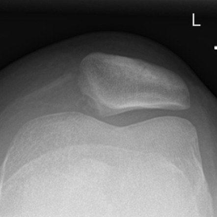 Patellar dislocation with chondral injury | Image | Radiopaedia.org