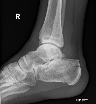 Lover's fracture | Radiology Reference Article | Radiopaedia.org