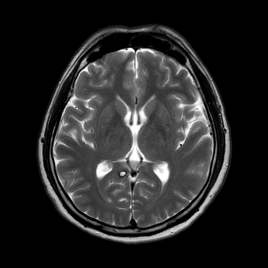 File:Familial multiple cavernous malformations, caused by KRIT-1 ...