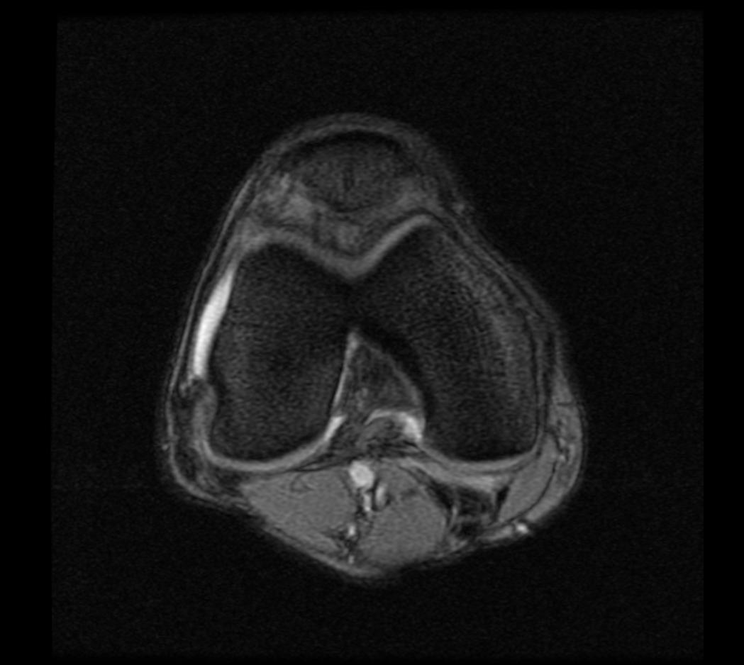 Bucket-handle Meniscal Tear | Image | Radiopaedia.org