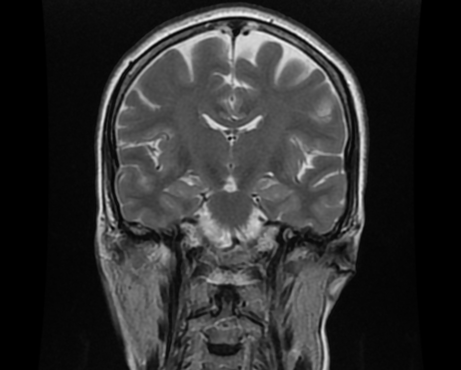 Retinal Detachment Image