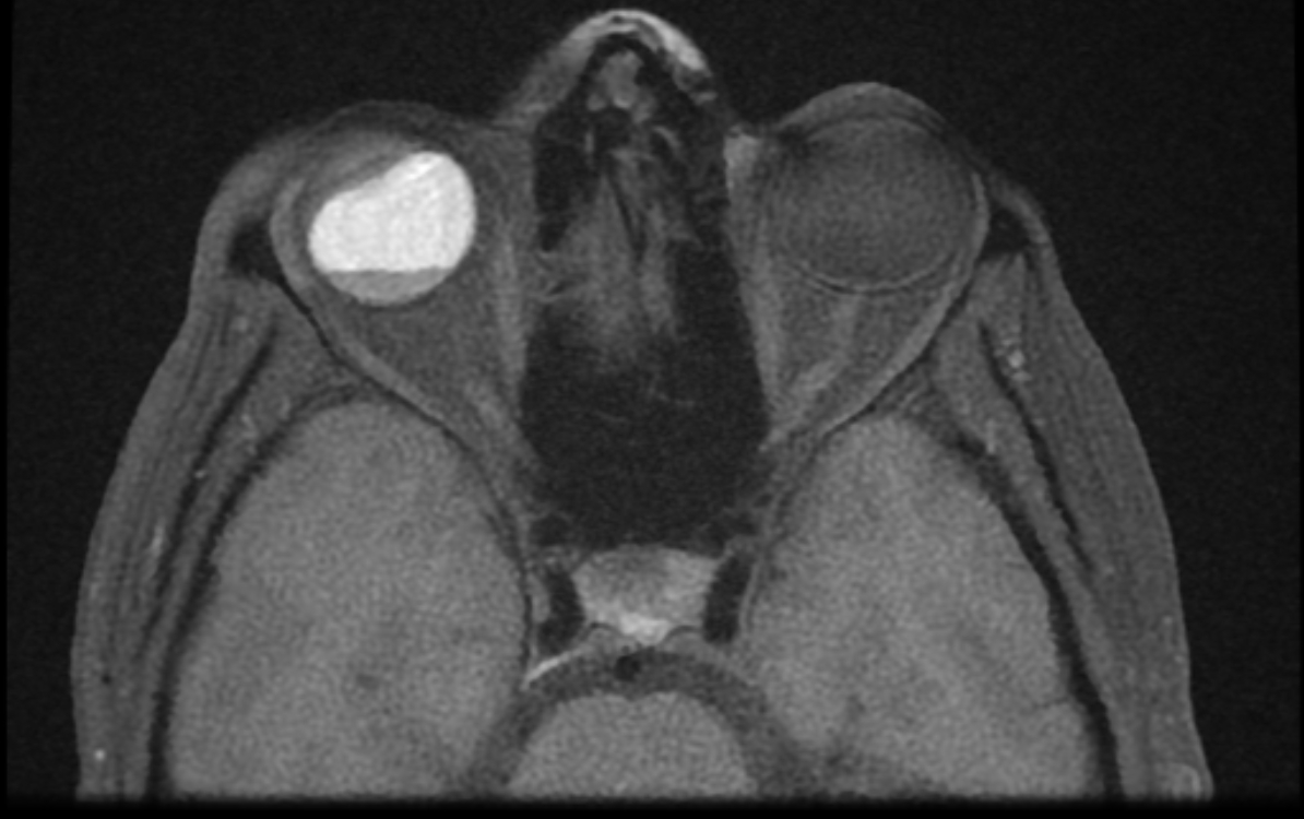 Retinal Detachment Image