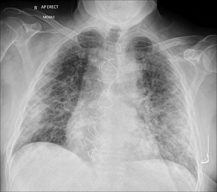 COVID-19 pneumonia - progressive | Radiology Case | Radiopaedia.org