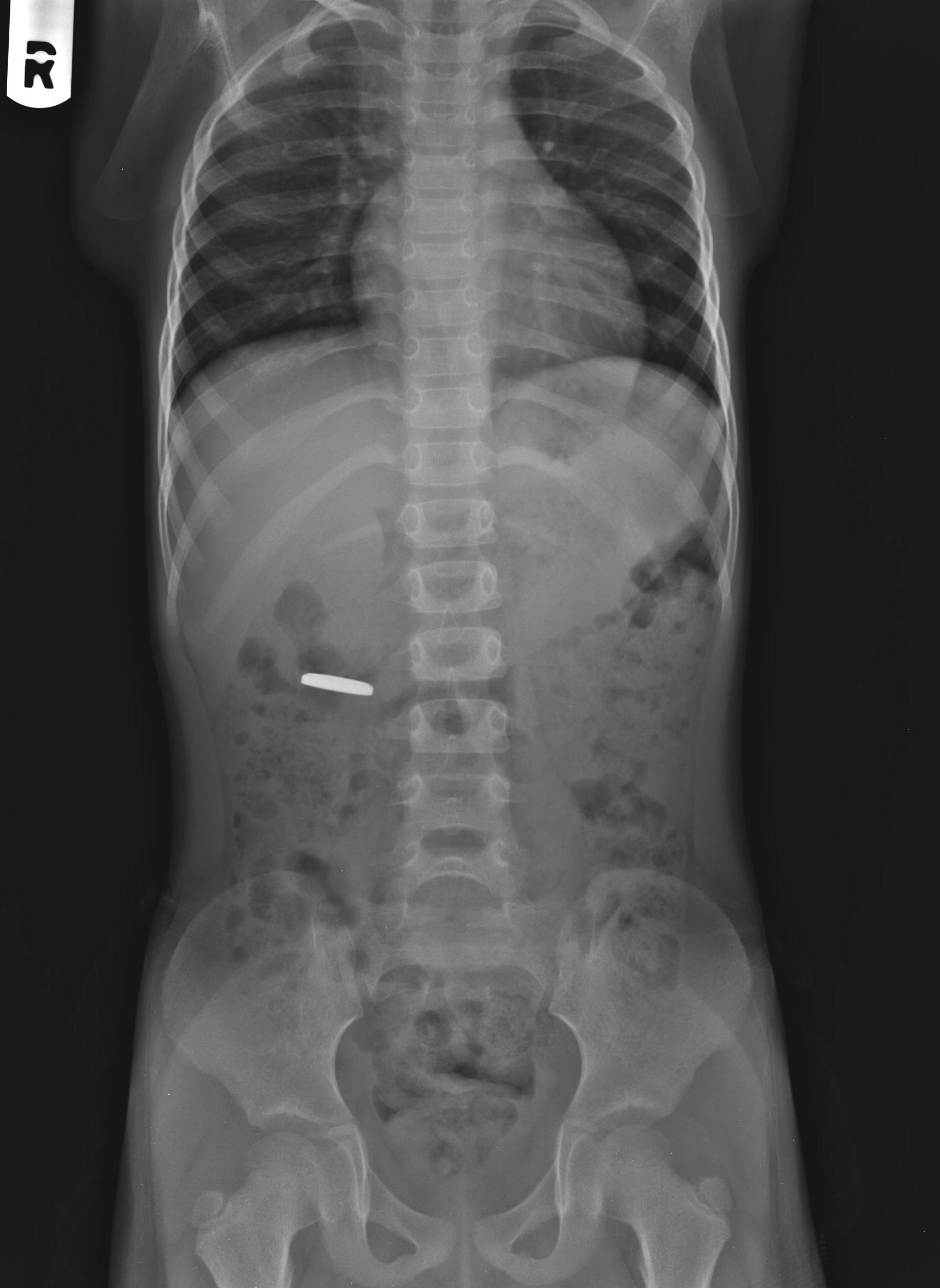 Coin Battery Xray at Lillian Reese blog