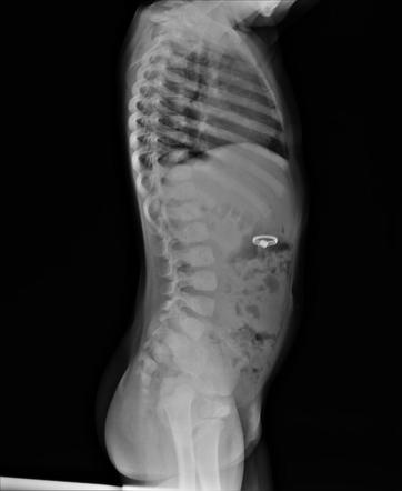 Foreign Body Ingestion | Image | Radiopaedia.org