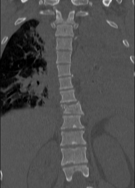 Fracture of the Thoracic and Lumbar Spine