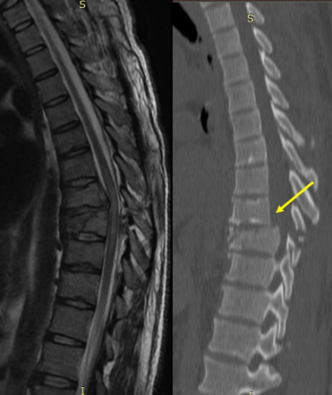 Translation-rotation thoracic spine injury | Image | Radiopaedia.org