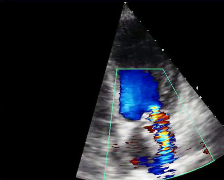 Infective endocarditis - large mobile vegetation | Image | Radiopaedia.org