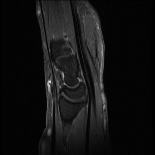 Median nerve schwannoma | Image | Radiopaedia.org