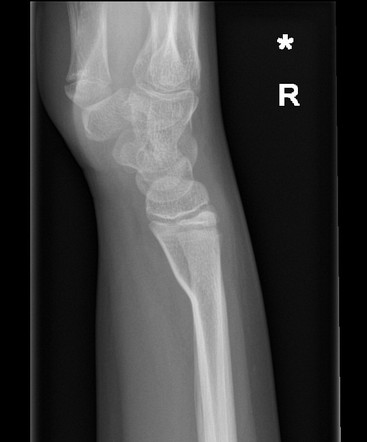 Volar buckle fracture distal radius | Image | Radiopaedia.org