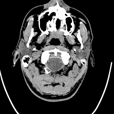 Choroid plexus papilloma | Radiology Case | Radiopaedia.org