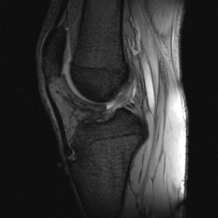 Osgood-Schlatter disease | Image | Radiopaedia.org