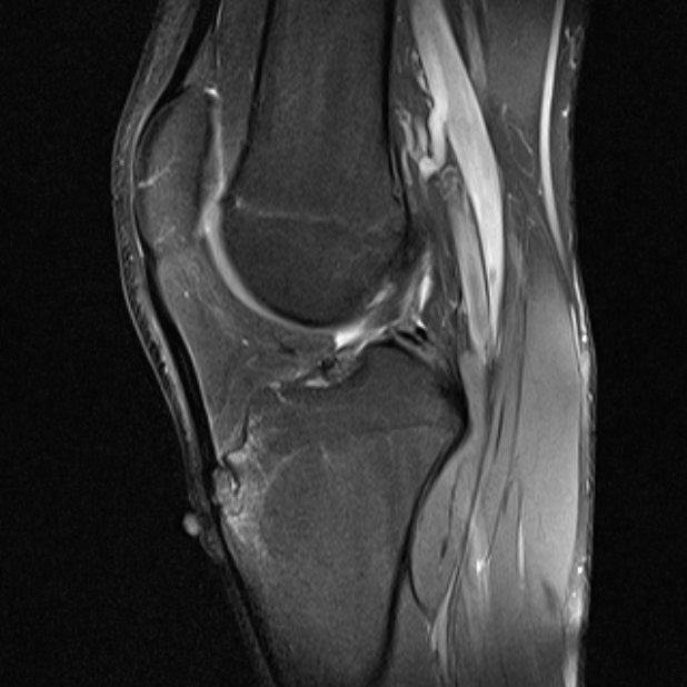 Osgood Schlatter Disease Image