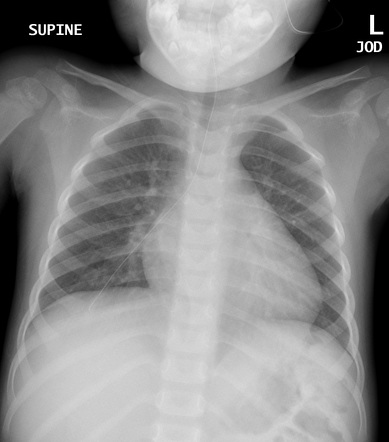 Malpositioned nasogastric tube | Radiology Case | Radiopaedia.org