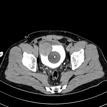 Bladder leiomyoma | Radiology Case | Radiopaedia.org