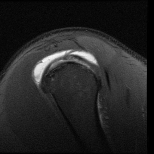 File:Full-thickness supraspinatus tear, HAGL and deficient ...